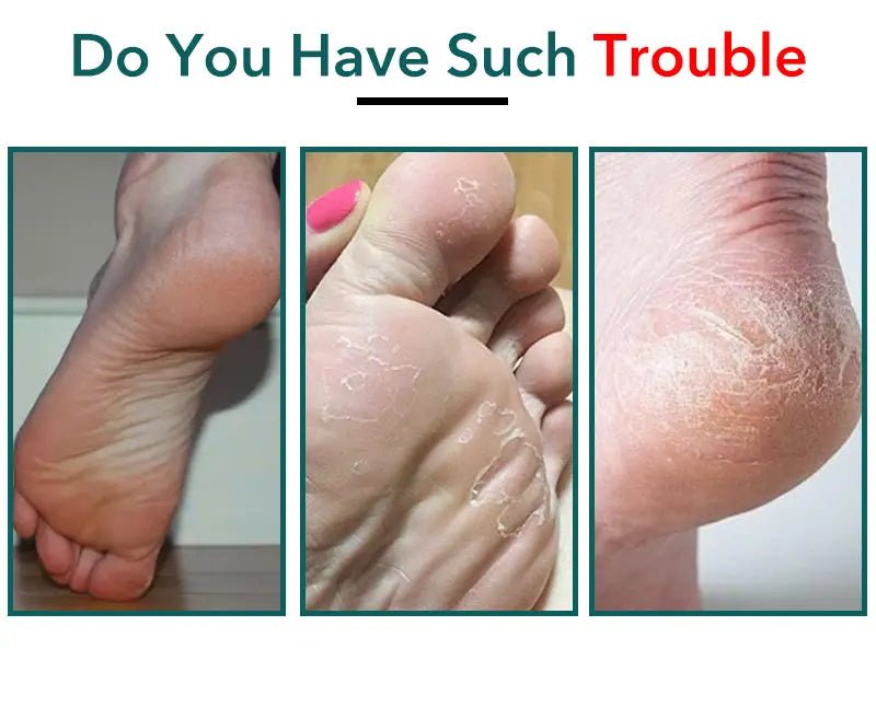 Stainless Steel Callus Remover